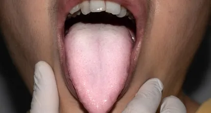 Oral Lichen Planus